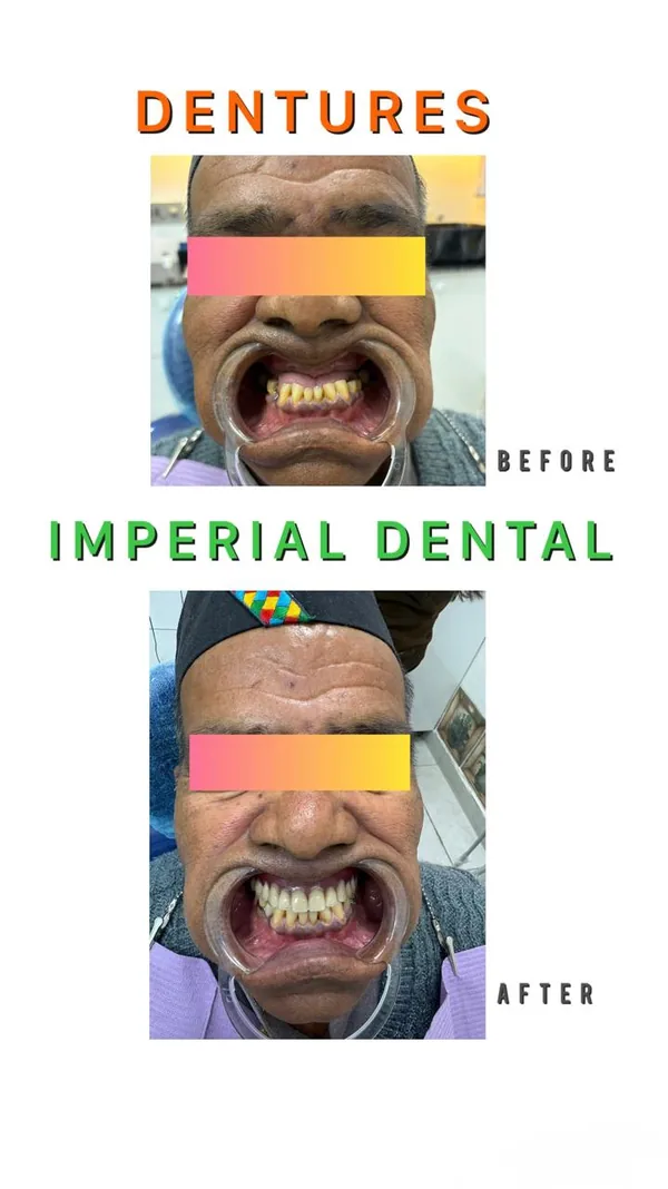 Before and after: new dentures fitted at Imperial Dental for a fuller smile