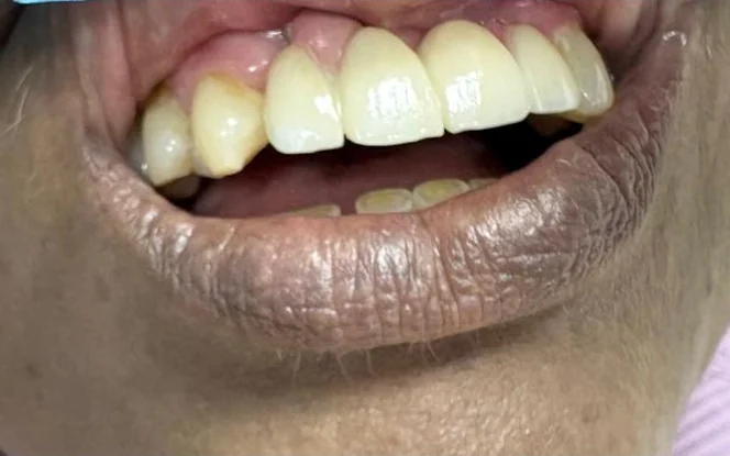 After: missing upper front teeth replaced with an implant-supported bridge at Imperial Dental