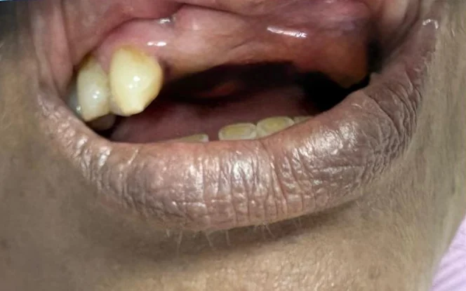 Before: gap from missing upper front teeth