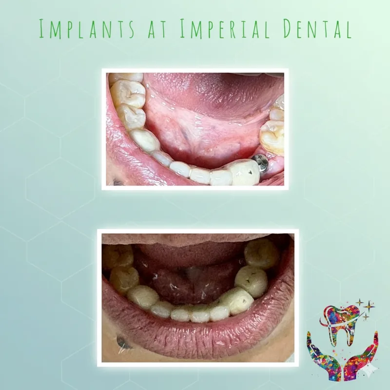 Dental implants case at Imperial Dental: implant post before the crown, then the final implant crowns