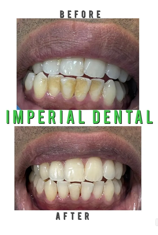 Before and after: heavy stains on lower teeth removed with professional cleaning at Imperial Dental